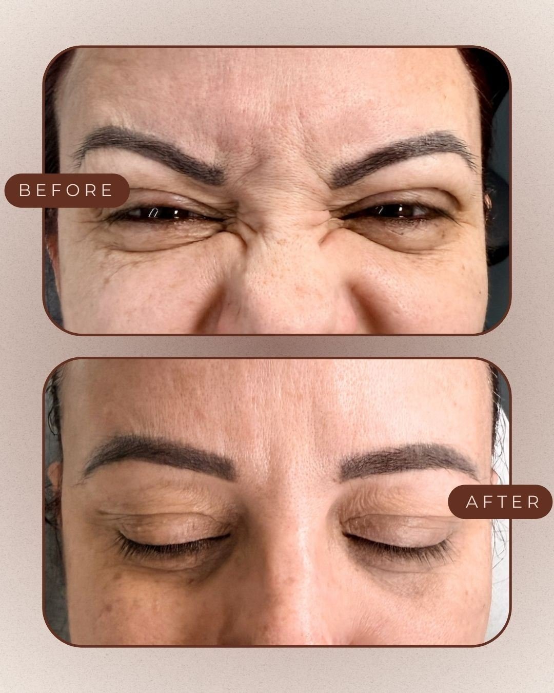 Before and after of Botox on crow's feet with natural movement preserved