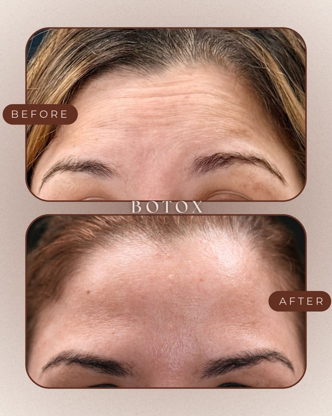 Before and after of Botox on forehead showing softened expression lines
