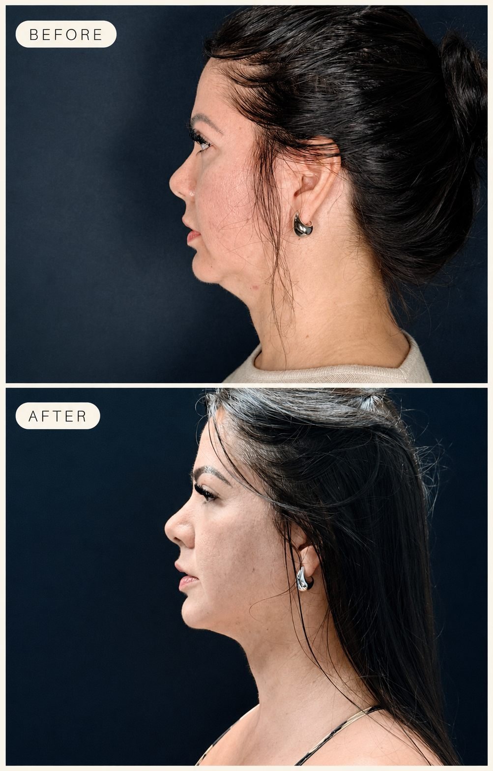Before and after of an Endolaser facial contour case at The Edit