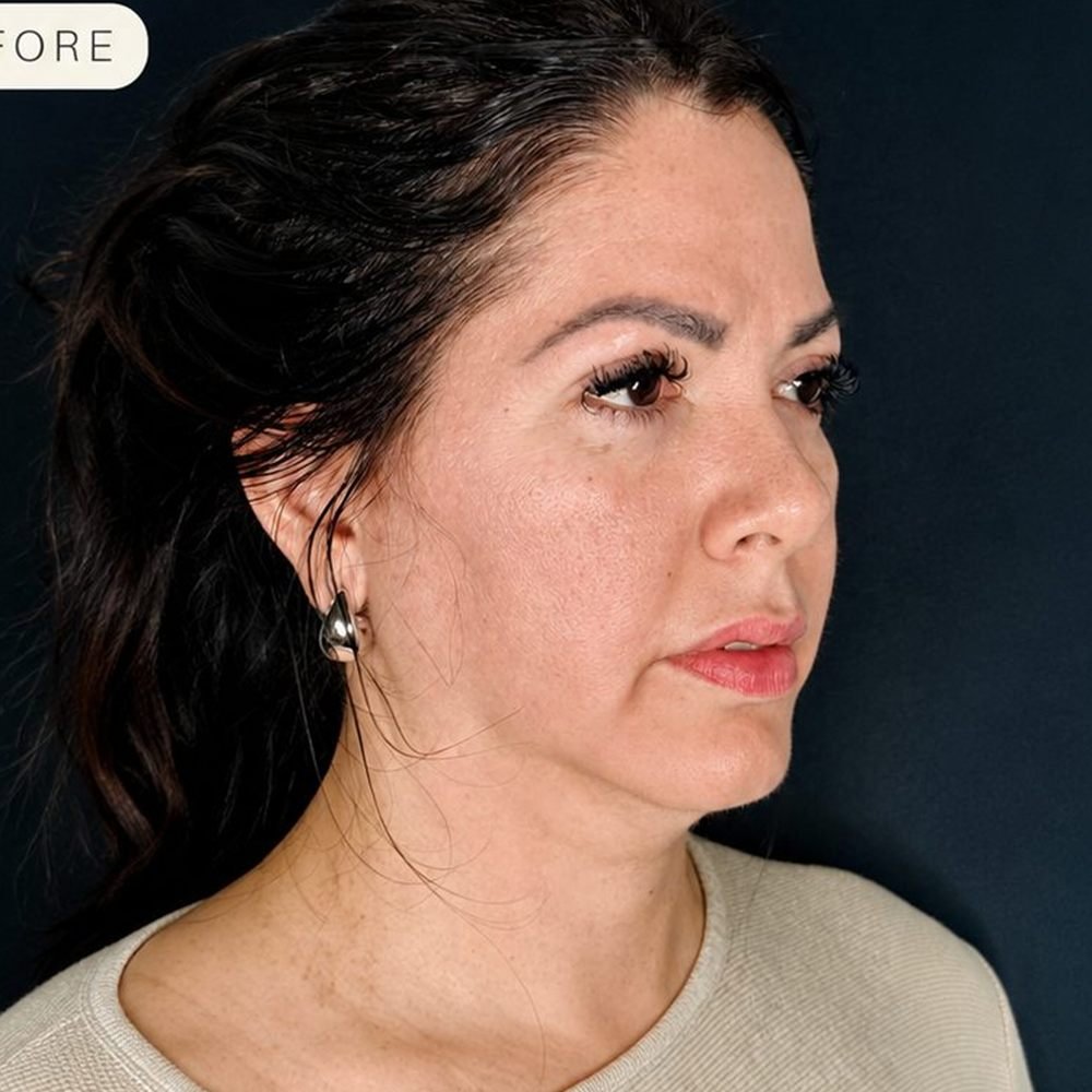 Side profile before Endolaser showing double chin and undefined jawline