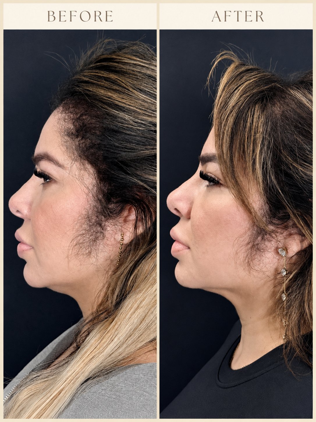 Side profile before and after Endolaser showing a slimmer, more defined jawline