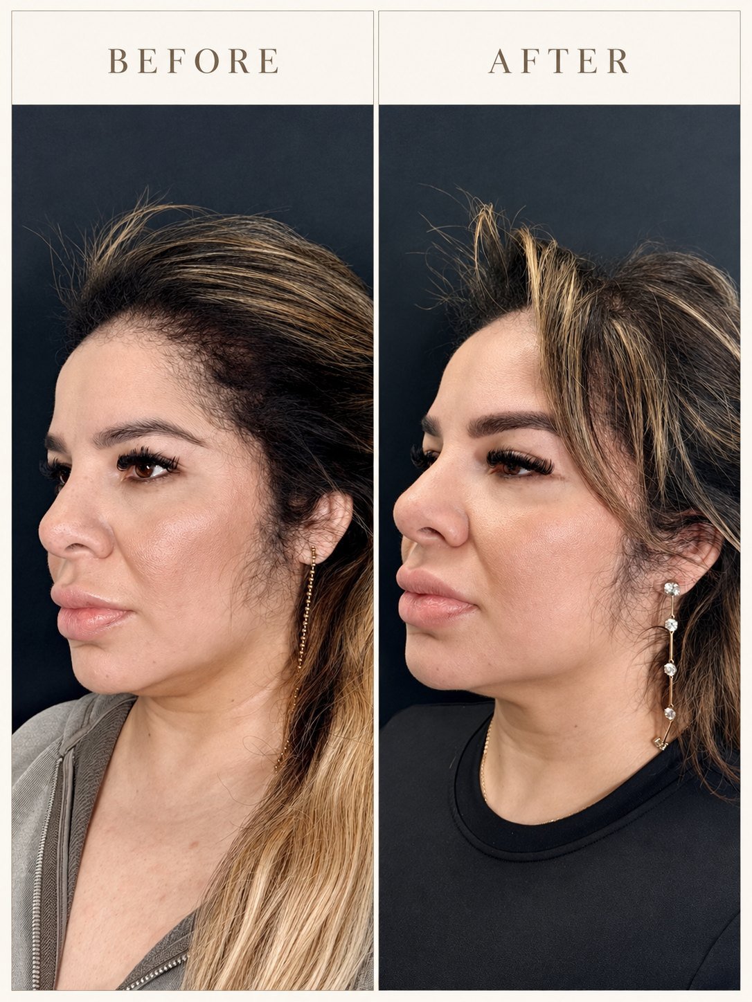 Three-quarter view before and after Endolaser with a tighter jawline and neck