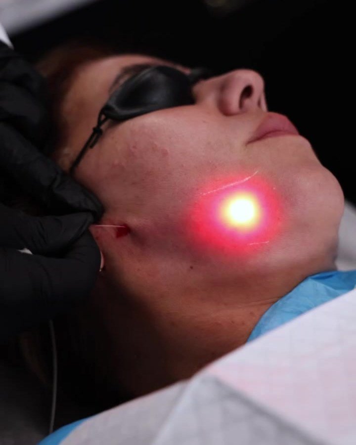 Laser glow along the jawline during a real Endolaser session at The Edit