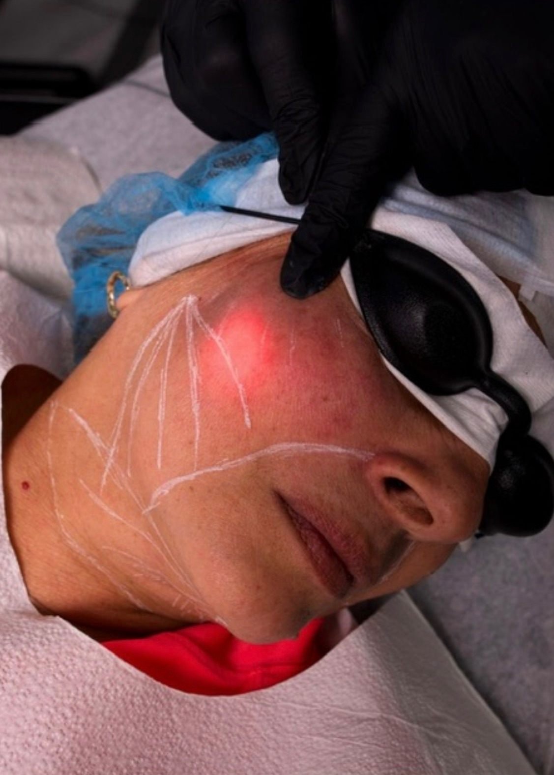 Endolaser session performed with the laser fiber device at The Edit