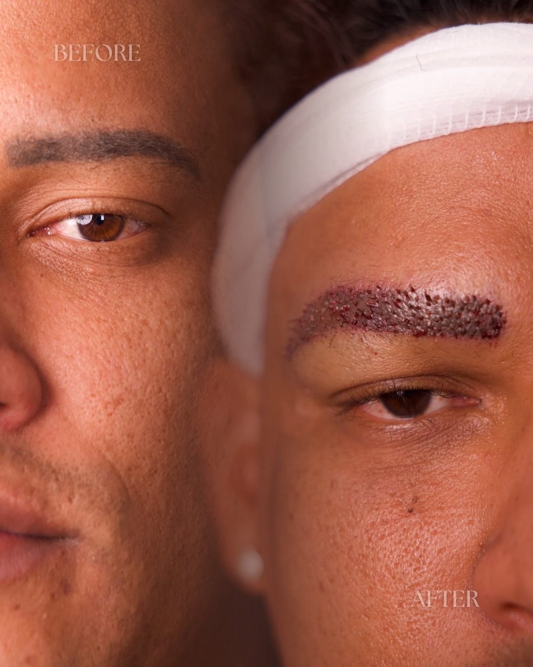 Eyebrow transplant patient before and after showing fuller, defined brows