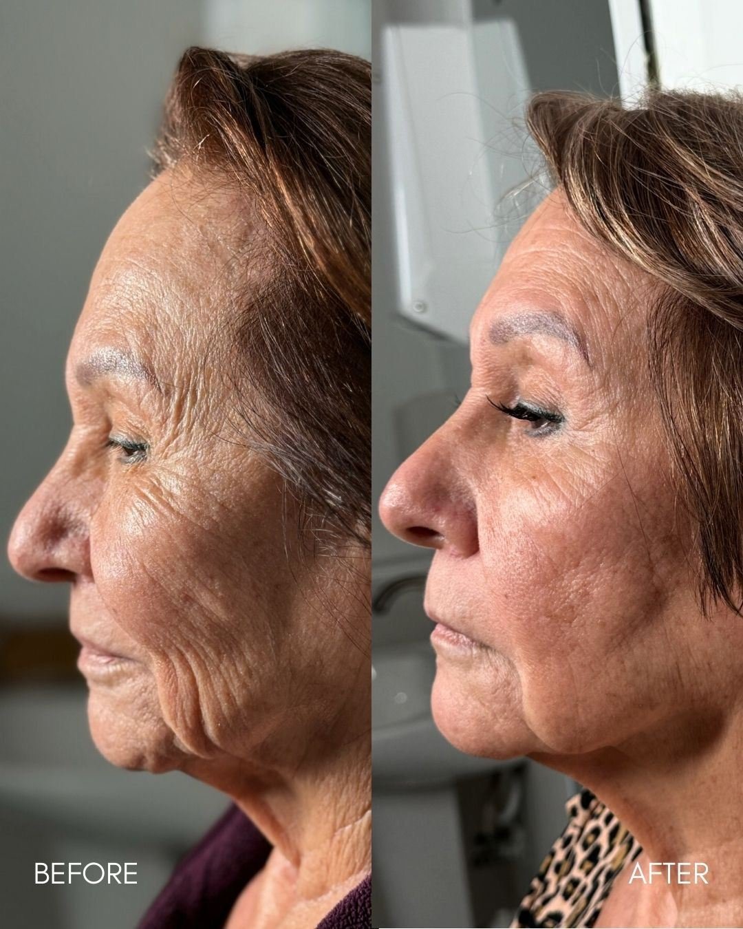 Before and after of fractional radiofrequency showing smoother skin texture and tighter pores