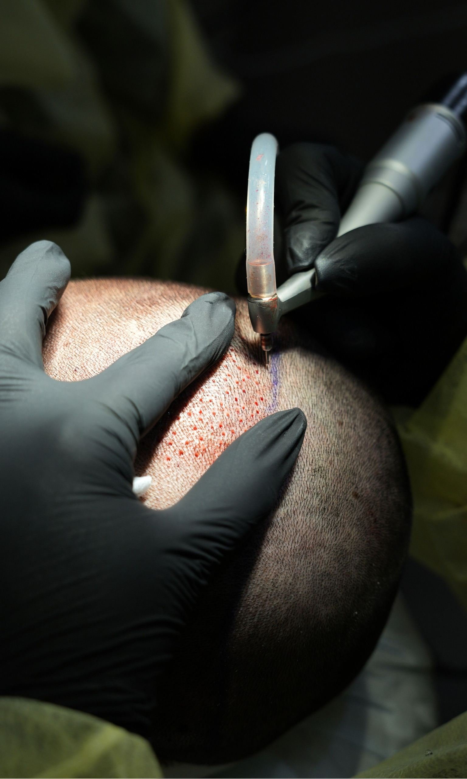 Close-up of follicular unit extraction performed with precision instruments