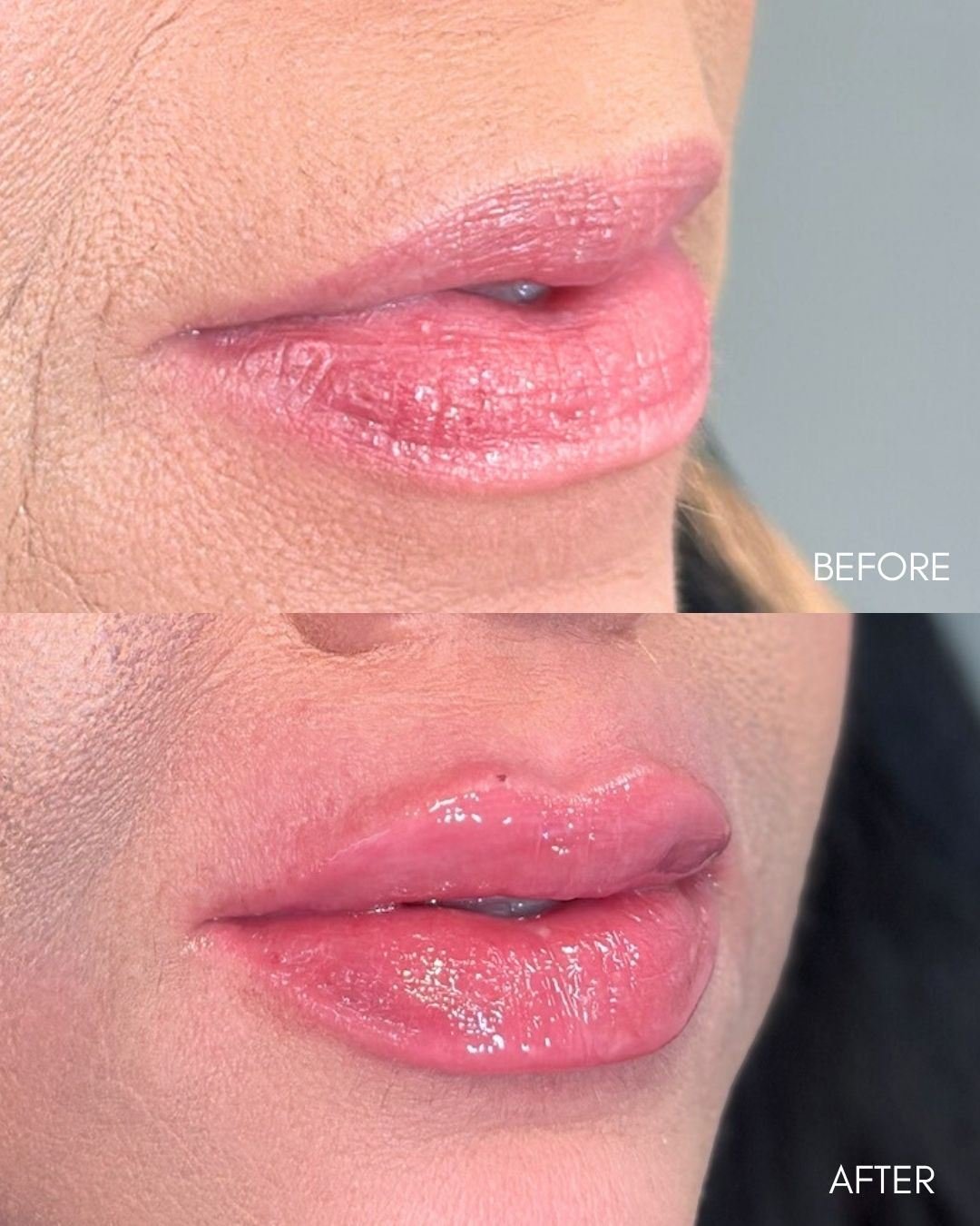 Before and after collage of lip filler restoring volume to thin lips