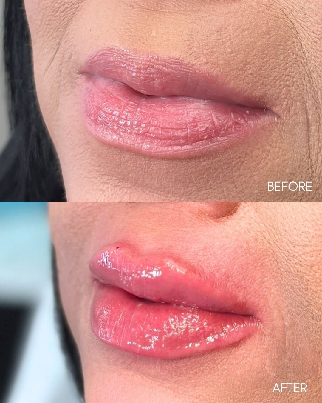 Before and after of lip filler with a natural result at The Edit