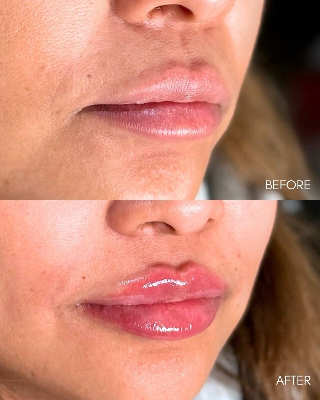 Before and after collage of lip filler with a subtle, hydrated result