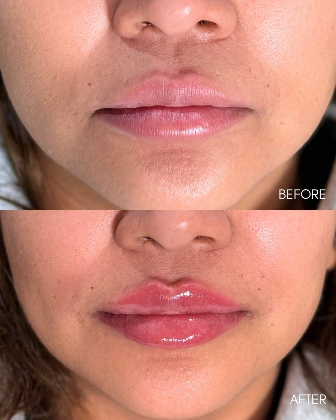 Before and after collage of lip filler adding shape while keeping natural proportions
