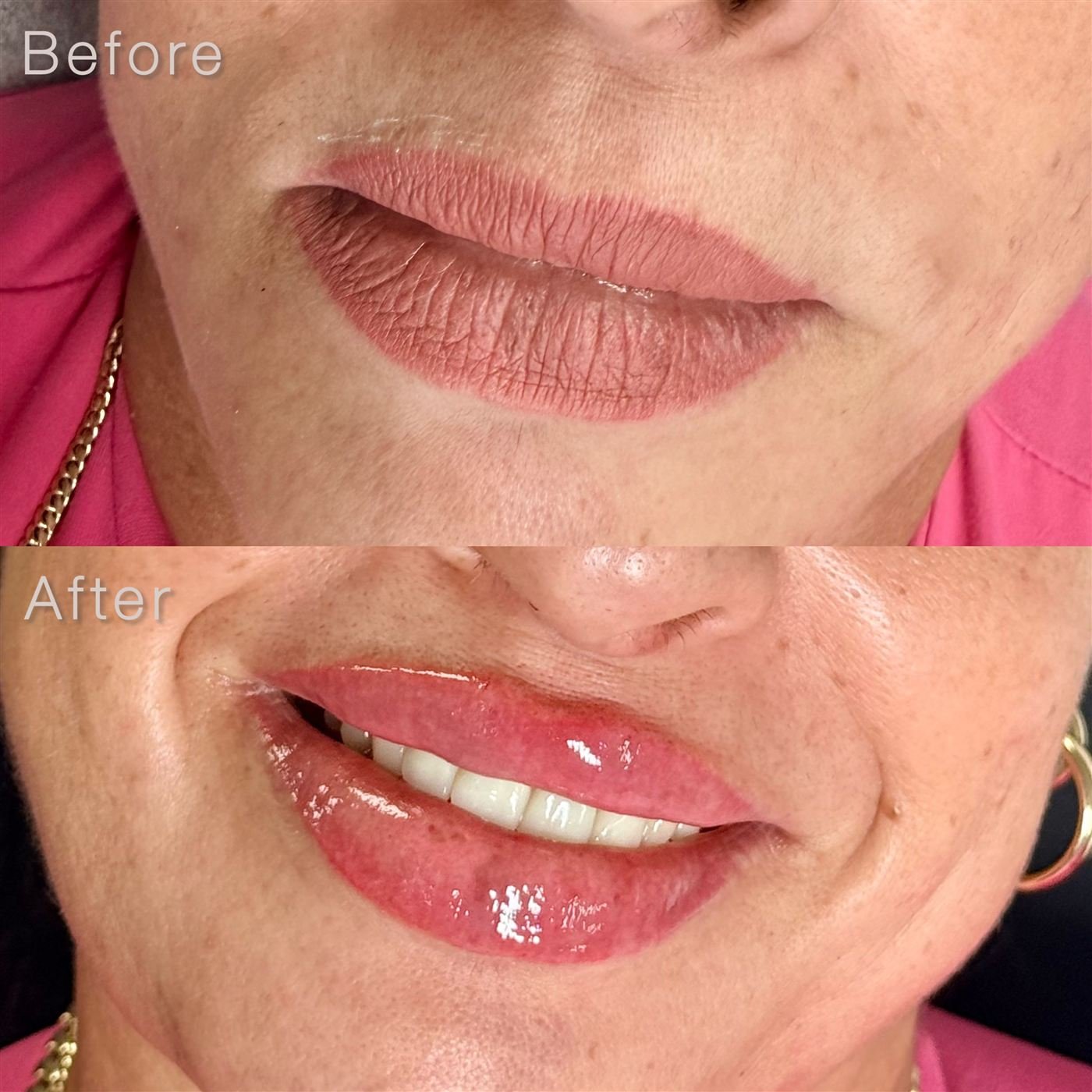 Before and after collage of a lip filler patient treated by Beatriz Duque at The Edit