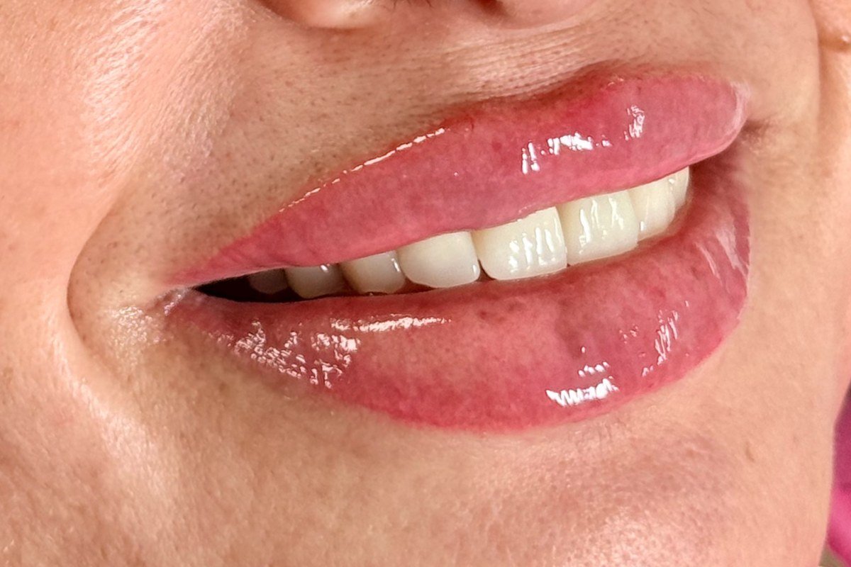 Lips after filler treatment with natural volume and definition