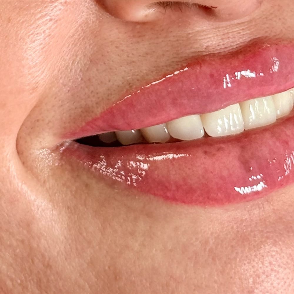 Lips after filler treatment with natural volume and definition