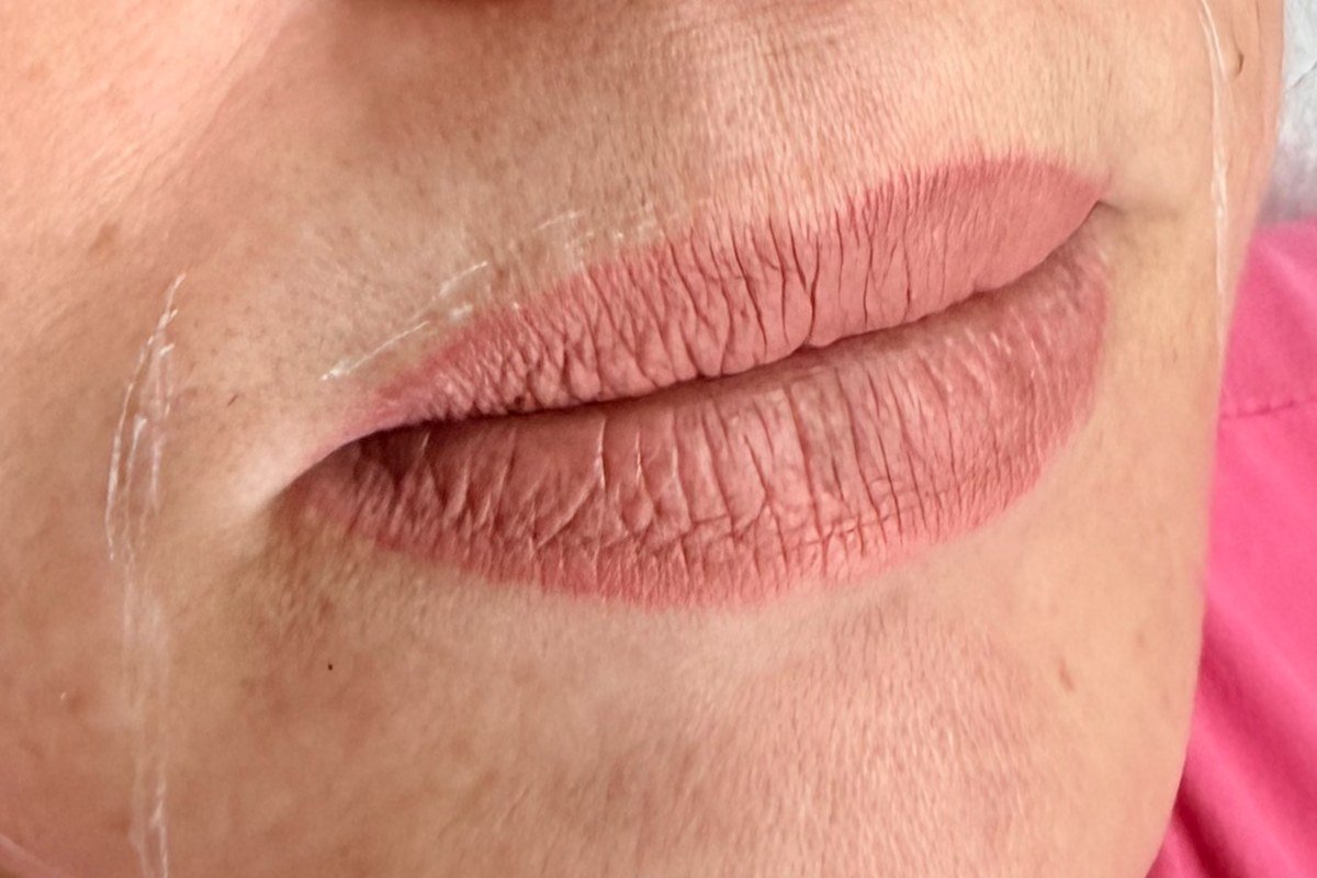 Lips before treatment showing loss of volume and lip lines